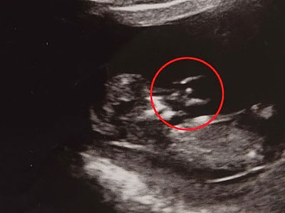 На внутриутробном снимке эмбриона разглядели ангела