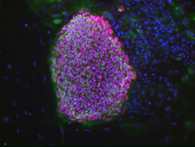 Колония эмбриональных клеток, клонированных от 32-летней женщины с диабетом 1 типа (фото Bjarki Johannesson, NYSCF). 